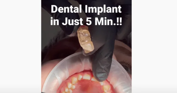 Dental-Implant-Video