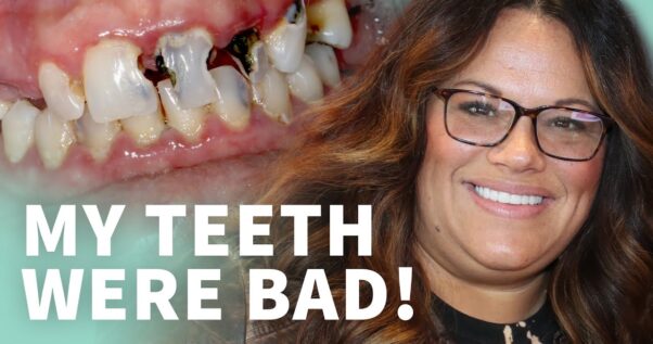 Text reads: my teeth were bad! Image of teeth before restoration, edited together with patient now who is smiling with white teeth.